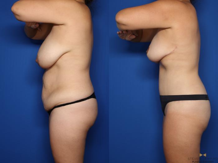 Before & After Tummy Tuck Case 623 Left Side View in Fort Worth & Arlington, Texas