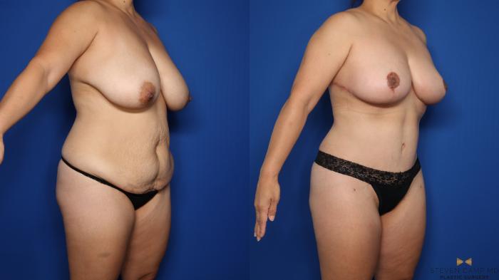 Before & After Tummy Tuck Case 623 Right Oblique View in Fort Worth & Arlington, Texas
