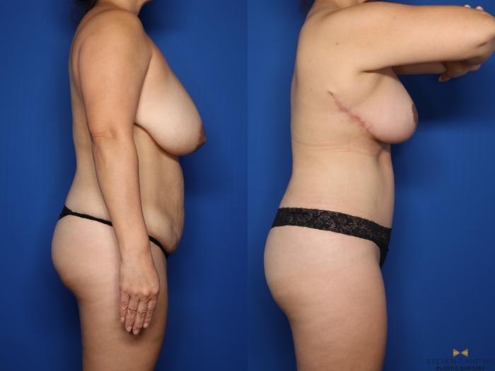 Before & After Tummy Tuck Case 623 Right Side View in Fort Worth & Arlington, Texas