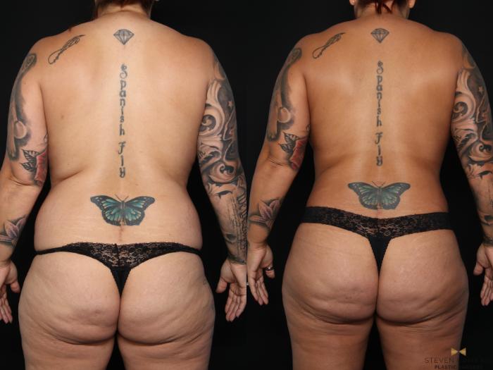 Before & After Breast Reduction Case 626 Back View in Fort Worth & Arlington, Texas