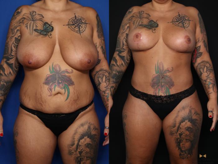 Before & After Tummy Tuck Case 626 Front View in Fort Worth & Arlington, Texas