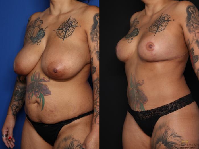 Before & After Tummy Tuck Case 626 Left Oblique View in Fort Worth & Arlington, Texas