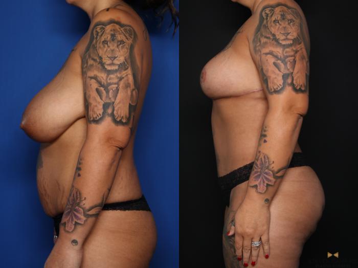 Before & After Tummy Tuck Case 626 Left Side View in Fort Worth & Arlington, Texas