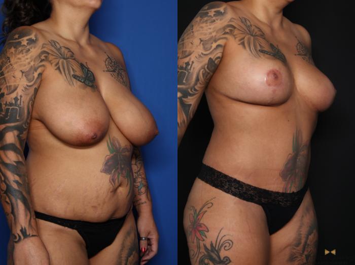 Before & After Mommy Makeover Case 626 Right Oblique View in Fort Worth & Arlington, Texas