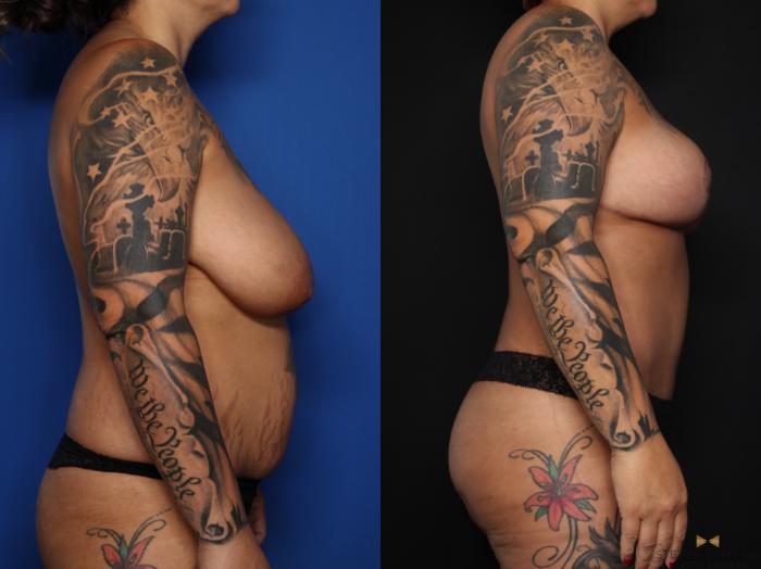 Before & After Tummy Tuck Case 626 Right Side View in Fort Worth & Arlington, Texas