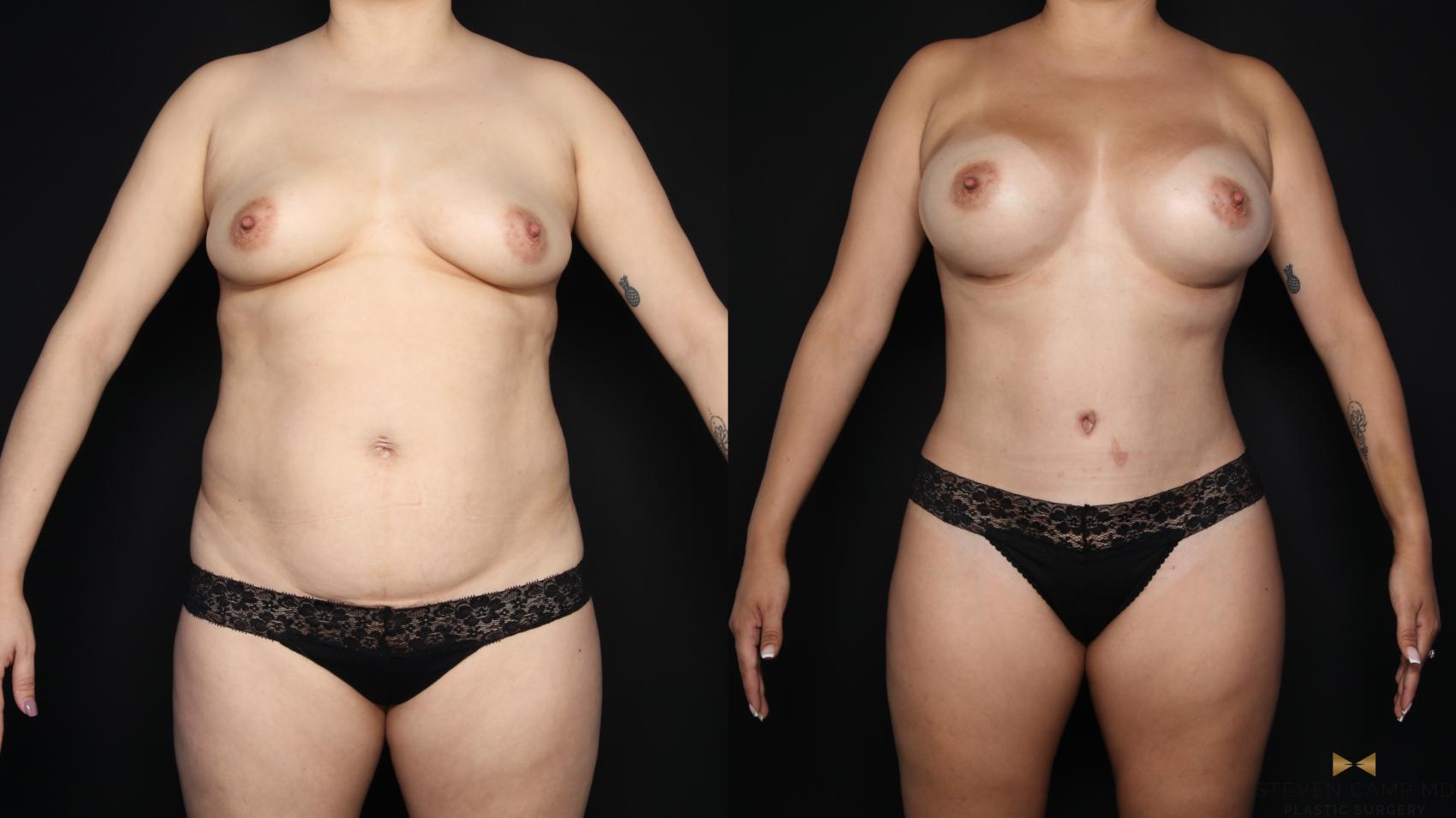 Before & After Mommy Makeover Case 635 Front View in Fort Worth & Arlington, Texas