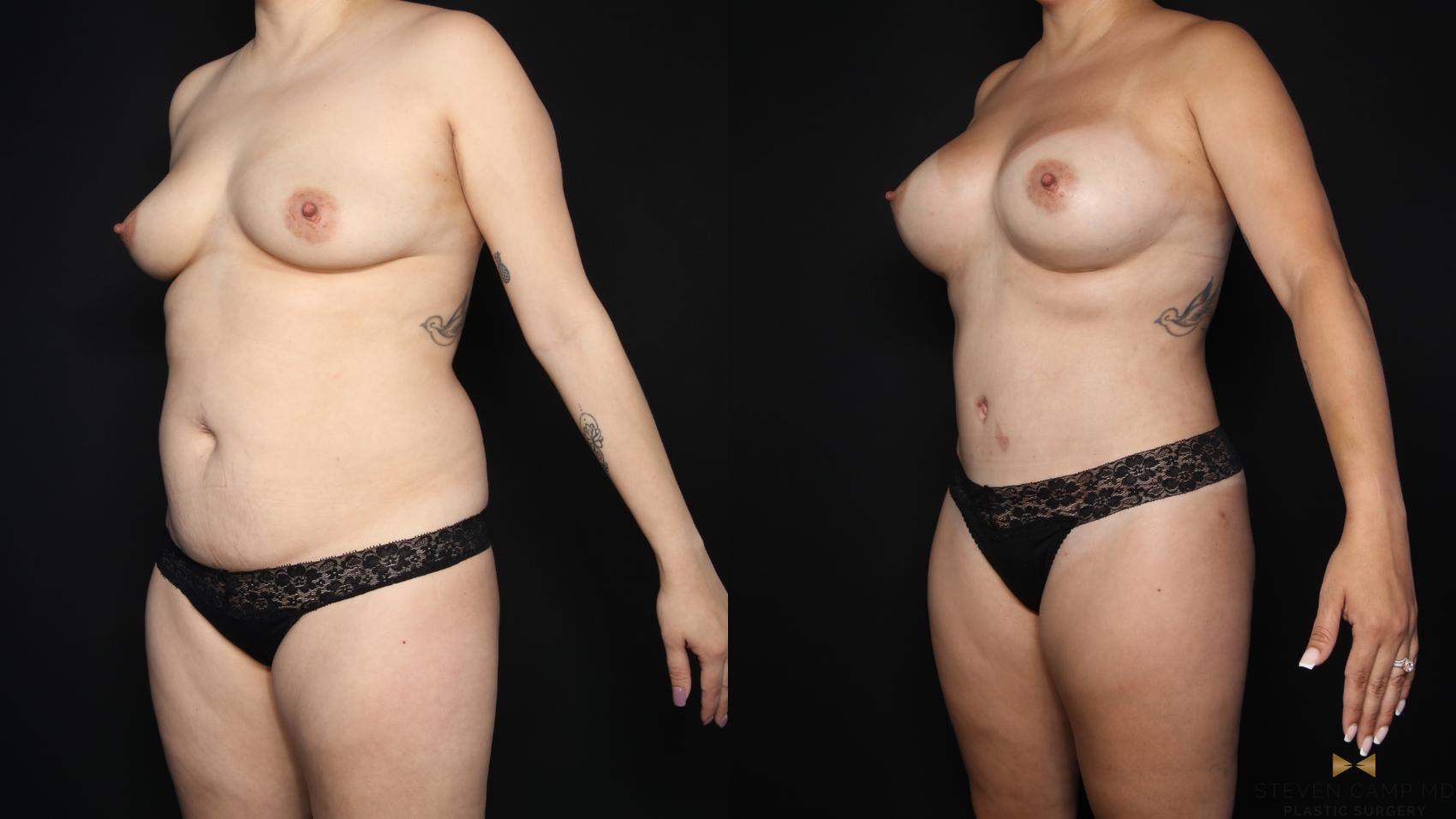 Before & After Mommy Makeover Case 635 Left Oblique View in Fort Worth & Arlington, Texas
