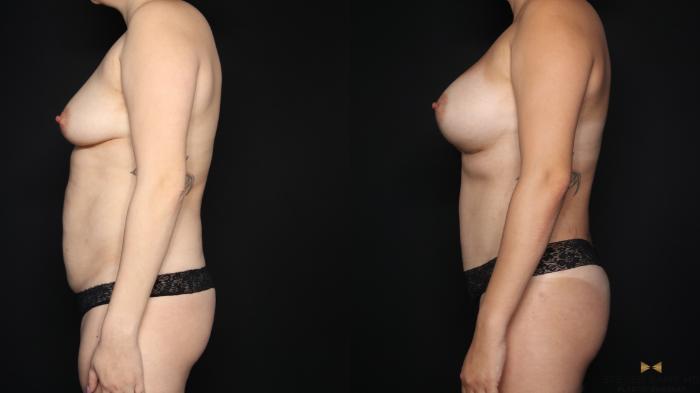Before & After Mommy Makeover Case 635 Left Side View in Fort Worth & Arlington, Texas