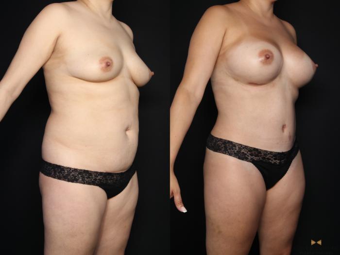 Before & After Mommy Makeover Case 635 Right Oblique View in Fort Worth & Arlington, Texas