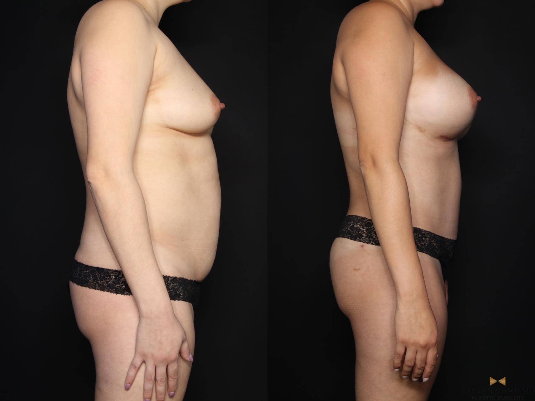 Before & After Mommy Makeover Case 635 Right Side View in Fort Worth & Arlington, Texas