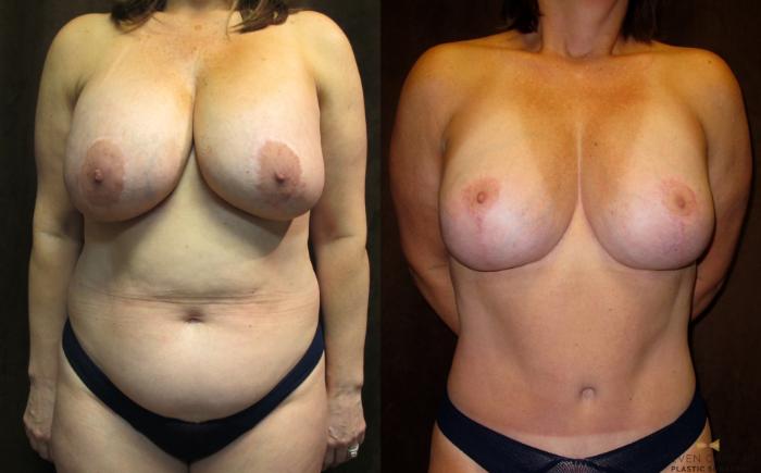 Before & After Tummy Tuck Case 64 View #1 View in Fort Worth & Arlington, Texas