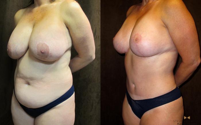 Before & After Tummy Tuck Case 64 View #2 View in Fort Worth & Arlington, Texas
