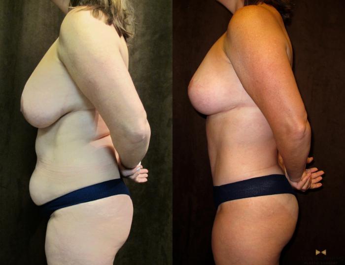 Before & After Tummy Tuck Case 64 View #3 View in Fort Worth & Arlington, Texas