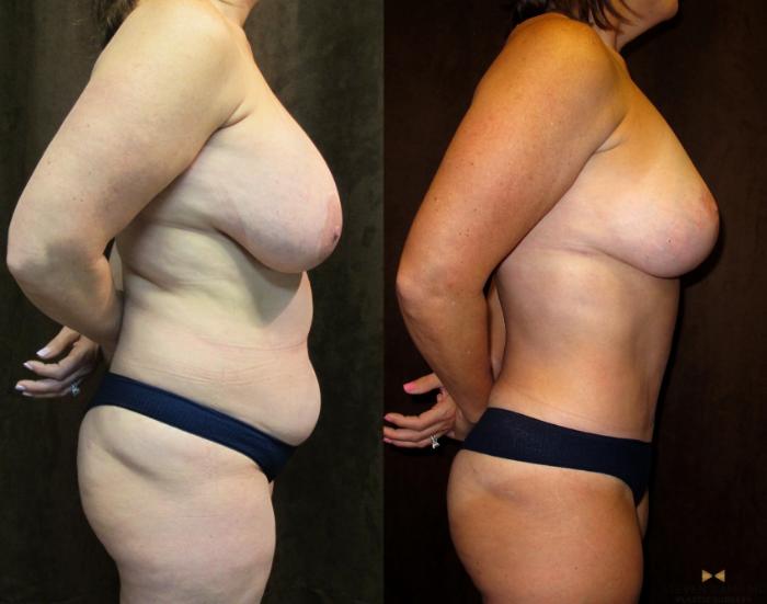 Before & After Tummy Tuck Case 64 View #5 View in Fort Worth & Arlington, Texas