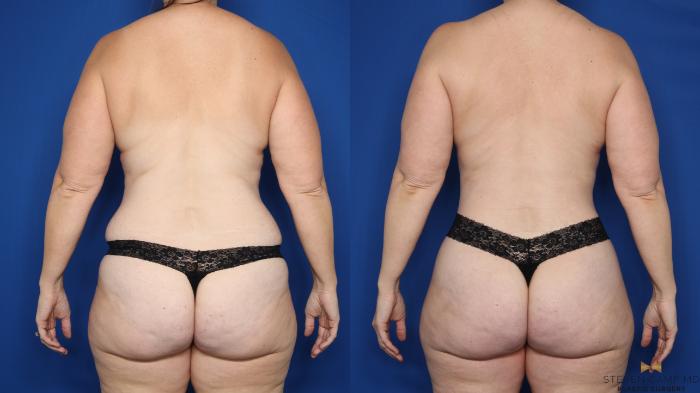Before & After Tummy Tuck Case 645 Back View in Fort Worth & Arlington, Texas