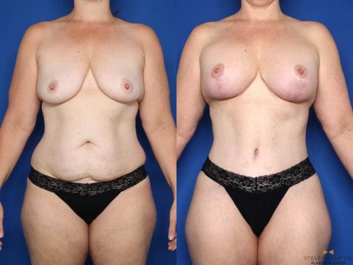 Before & After Mommy Makeover Case 645 Front View in Fort Worth & Arlington, Texas