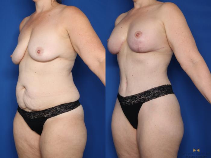 Before & After Tummy Tuck Case 645 Left Oblique View in Fort Worth & Arlington, Texas