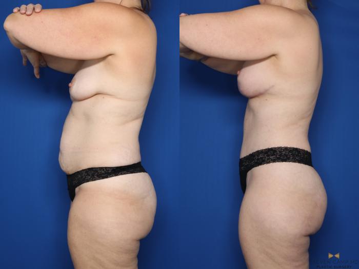 Before & After Mommy Makeover Case 645 Left Side View in Fort Worth & Arlington, Texas