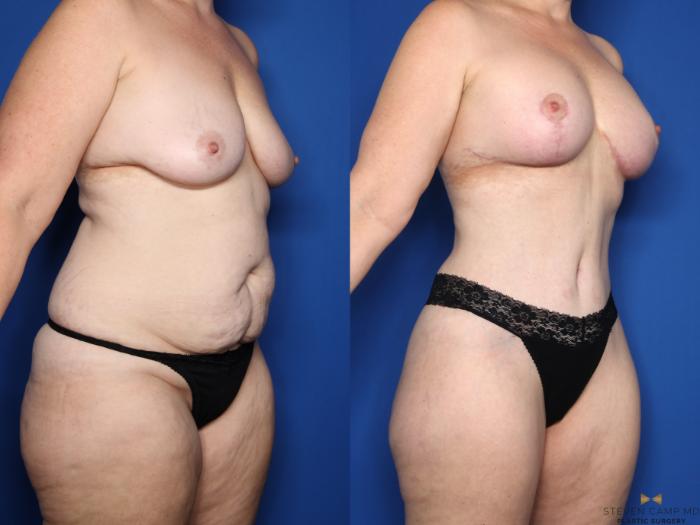 Before & After Mommy Makeover Case 645 Right Oblique View in Fort Worth & Arlington, Texas