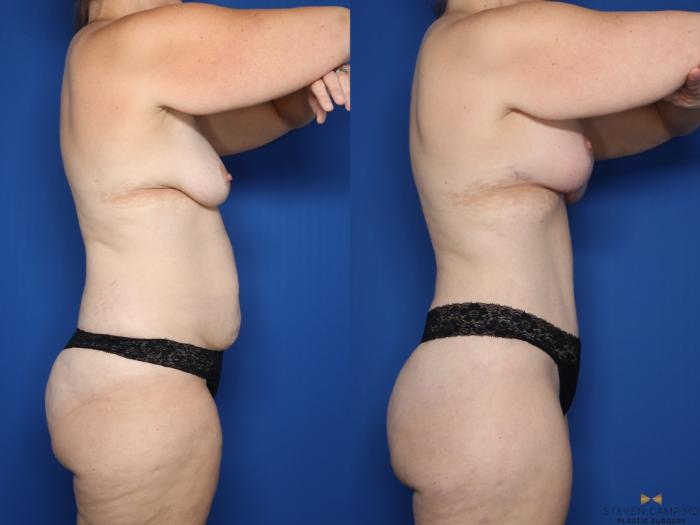 Before & After Tummy Tuck Case 645 Right Side View in Fort Worth & Arlington, Texas