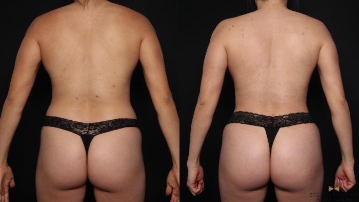 Before & After Brazilian Butt Lift Case 648 Back View in Fort Worth & Arlington, Texas