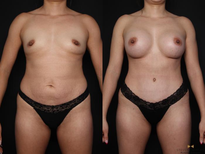 Before & After Tummy Tuck Case 648 Front View in Fort Worth & Arlington, Texas