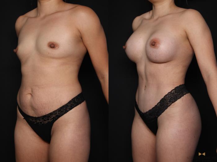 Before & After Tummy Tuck Case 648 Left Oblique View in Fort Worth & Arlington, Texas