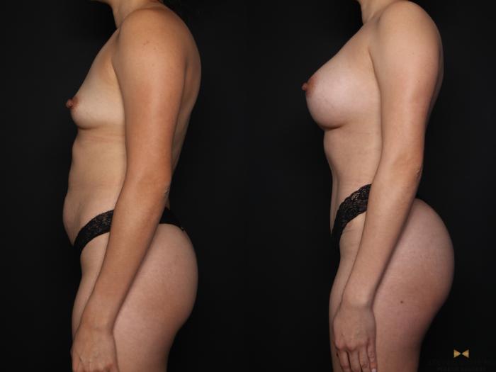 Before & After Tummy Tuck Case 648 Left Side View in Fort Worth & Arlington, Texas