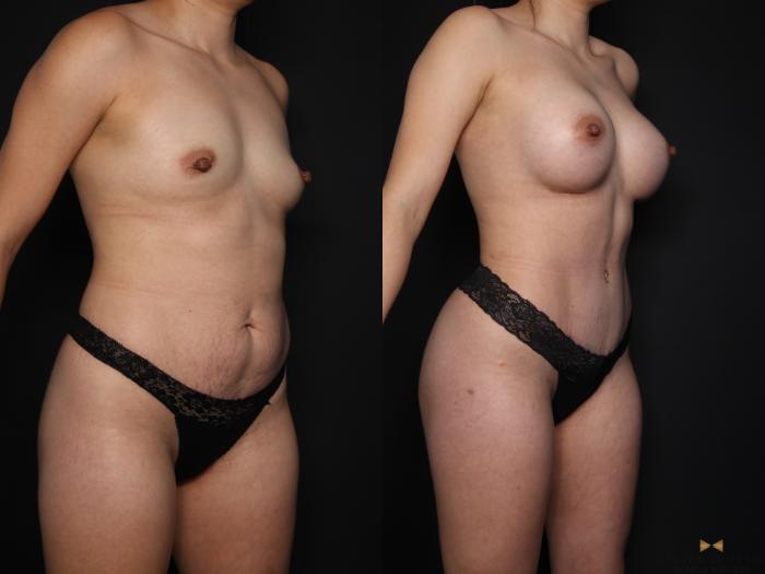 Before & After Tummy Tuck Case 648 Right Oblique View in Fort Worth & Arlington, Texas