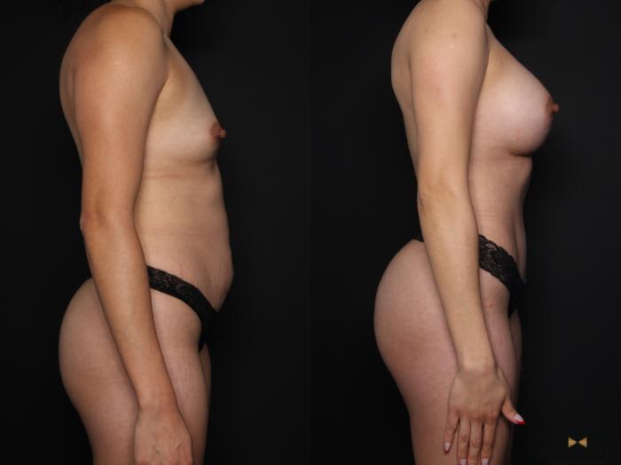 Before & After Tummy Tuck Case 648 Right Side View in Fort Worth & Arlington, Texas