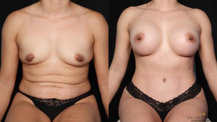 Before & After Tummy Tuck Case 648 Seated View in Fort Worth & Arlington, Texas