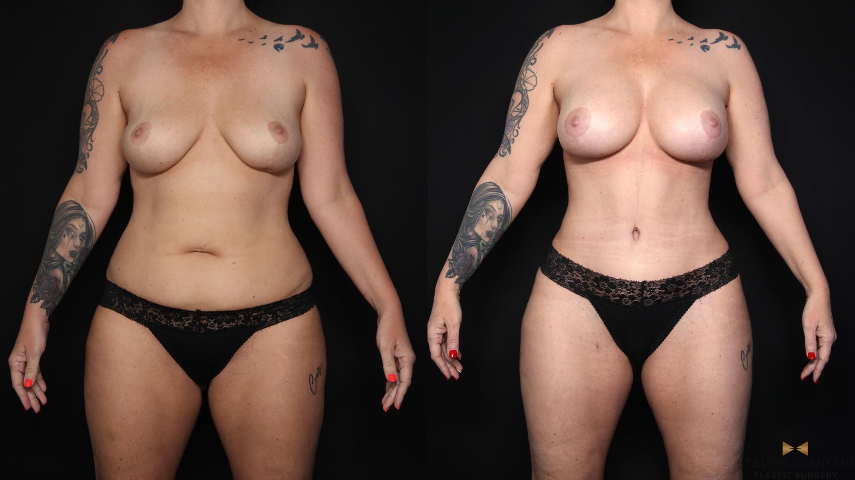 Before & After Breast Augmentation Case 650 Front View in Fort Worth & Arlington, Texas