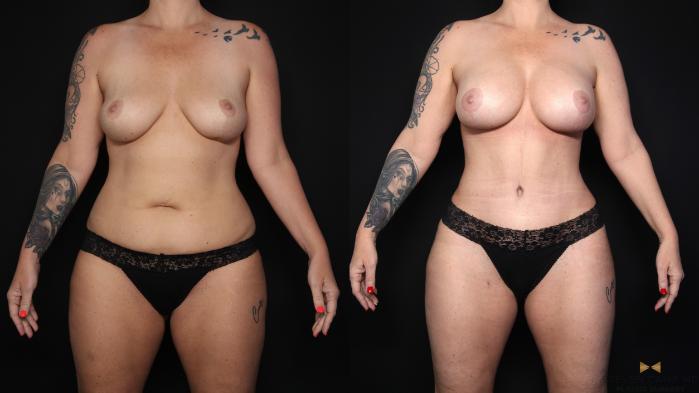Before & After Breast Augmentation Case 650 Front View in Fort Worth & Arlington, Texas