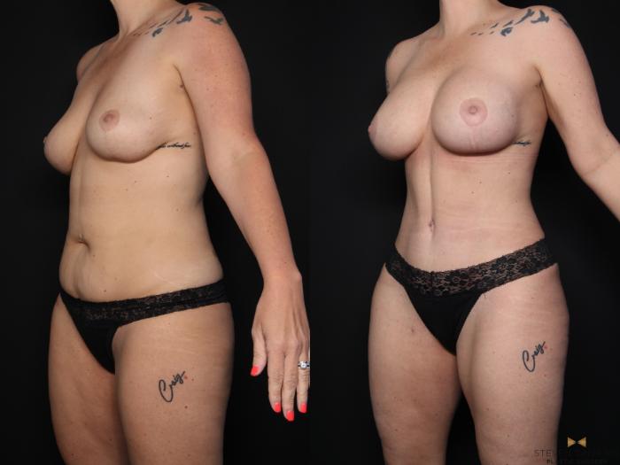 Before & After Liposuction Case 650 Left Oblique View in Fort Worth & Arlington, Texas