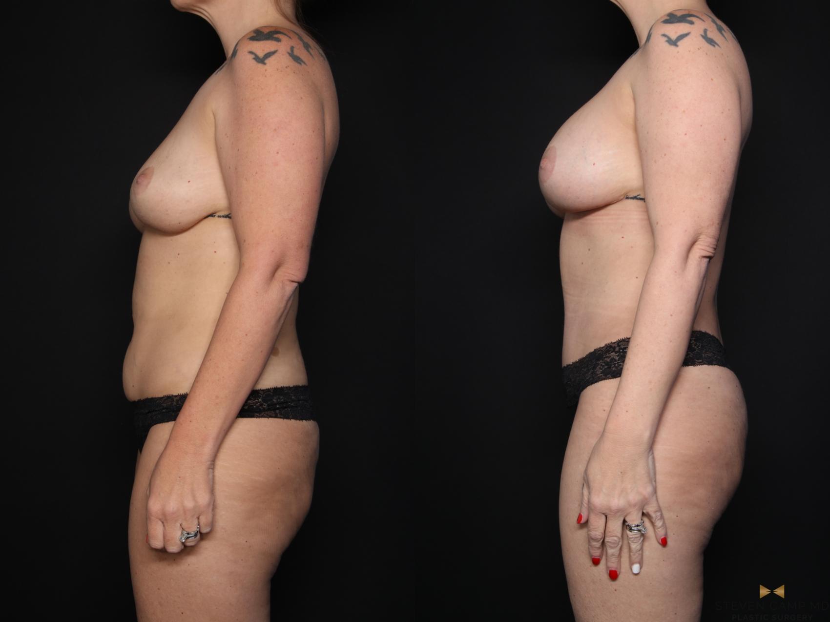Before & After Mommy Makeover Case 650 Left Side View in Fort Worth & Arlington, Texas