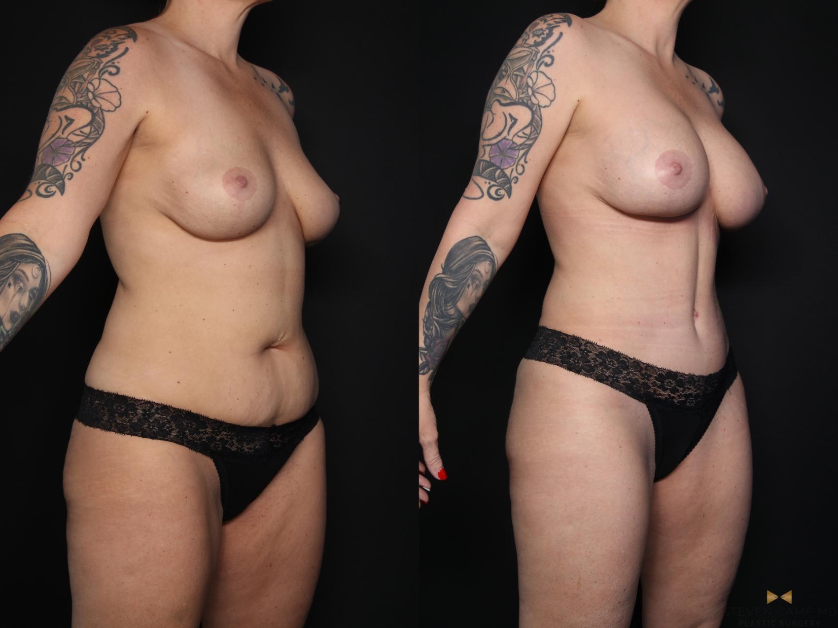 Before & After Mommy Makeover Case 650 Right Oblique View in Fort Worth & Arlington, Texas