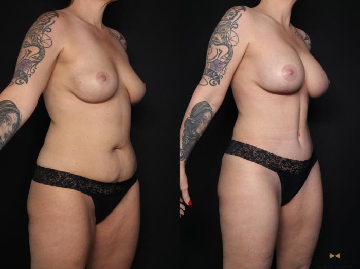 Before & After Breast Augmentation Case 650 Right Oblique View in Fort Worth & Arlington, Texas