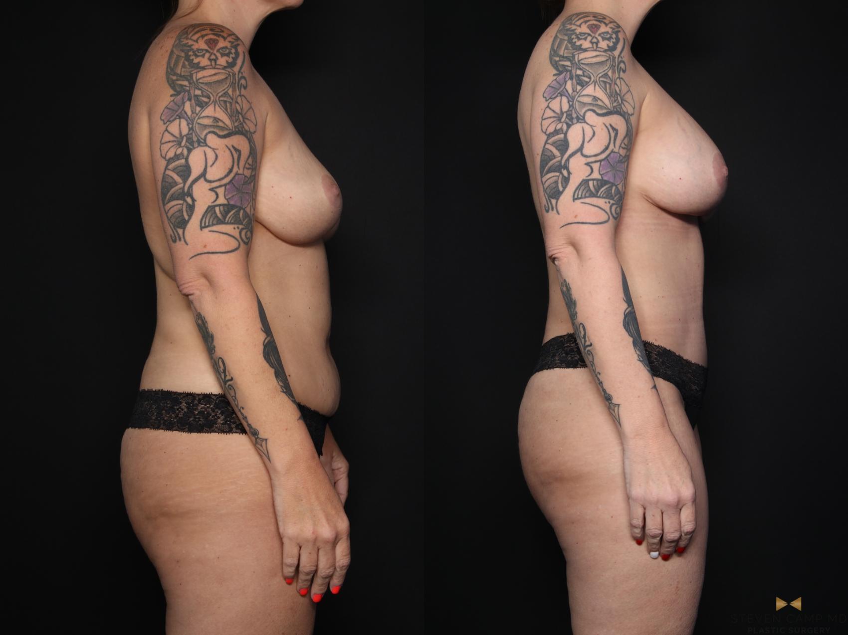 Before & After Mommy Makeover Case 650 Right Side View in Fort Worth & Arlington, Texas