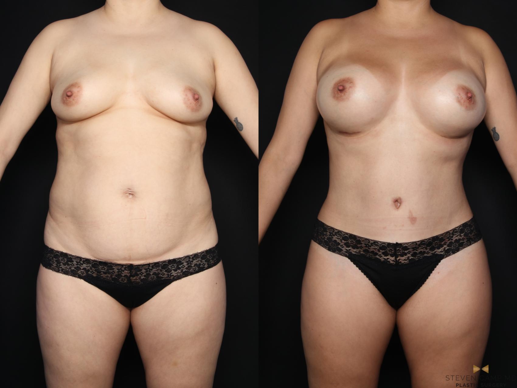 Before & After Liposuction Case 659 Front View in Fort Worth & Arlington, Texas
