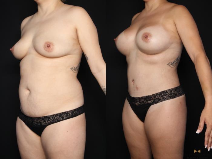 Before & After Mommy Makeover Case 659 Left Oblique View in Fort Worth & Arlington, Texas