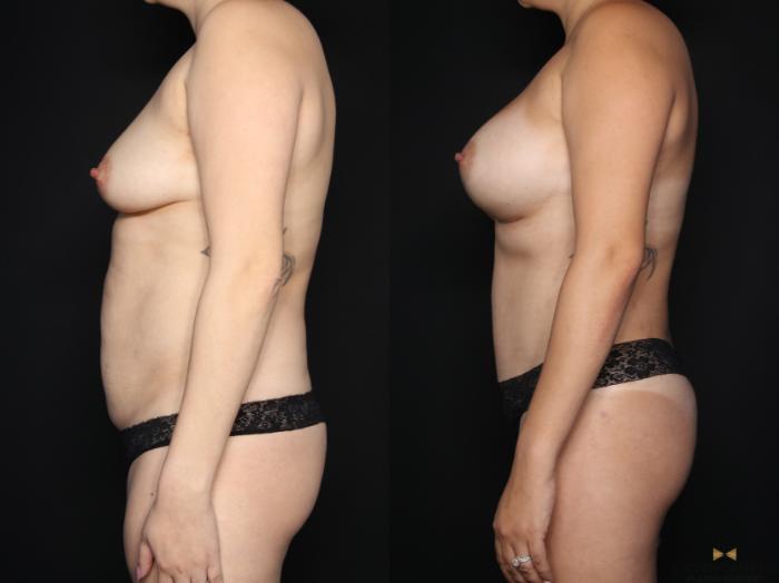 Before & After Mommy Makeover Case 659 Left Side View in Fort Worth & Arlington, Texas