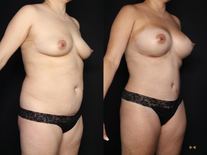 Before & After Mommy Makeover Case 659 Right Oblique View in Fort Worth & Arlington, Texas