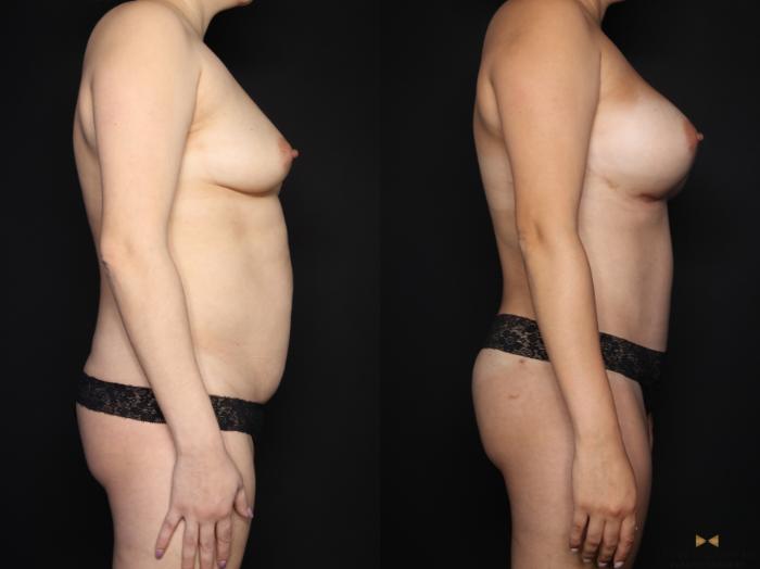 Before & After Liposuction Case 659 Right Side View in Fort Worth & Arlington, Texas