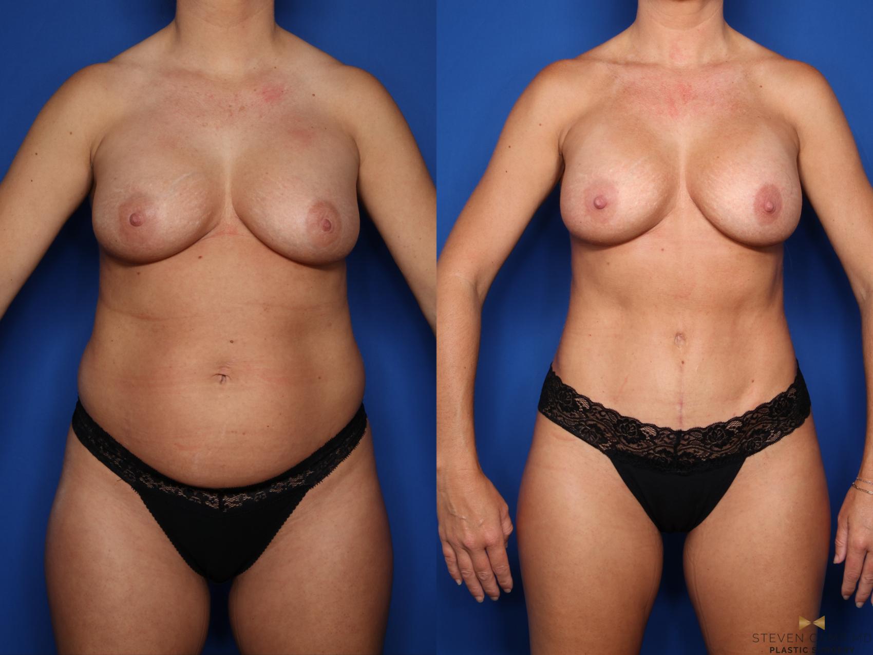 Before & After Liposuction Case 683 Front View in Fort Worth & Arlington, Texas