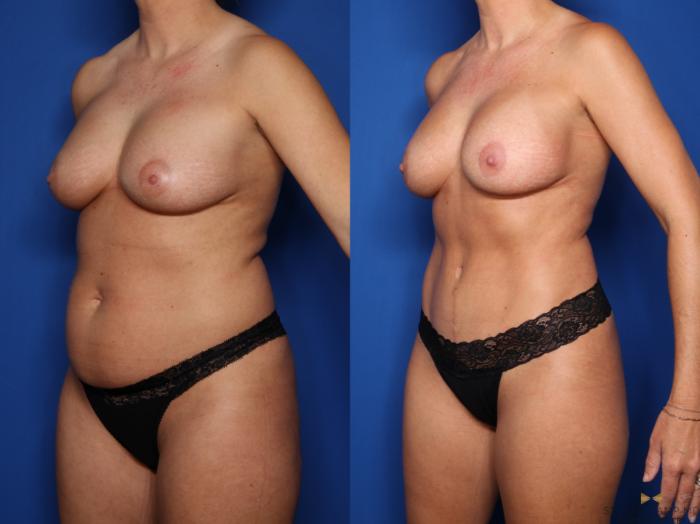 Before & After Internal Bra (Galaflex) Case 683 Left Oblique View in Fort Worth & Arlington, Texas