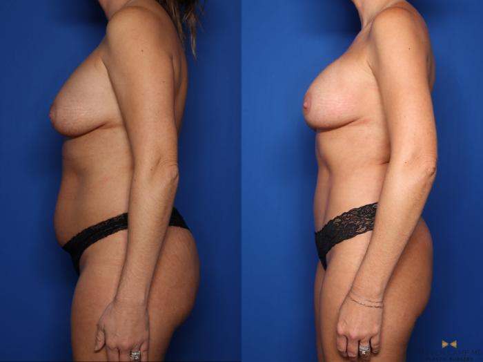 Before & After Mommy Makeover Case 683 Left Side View in Fort Worth & Arlington, Texas