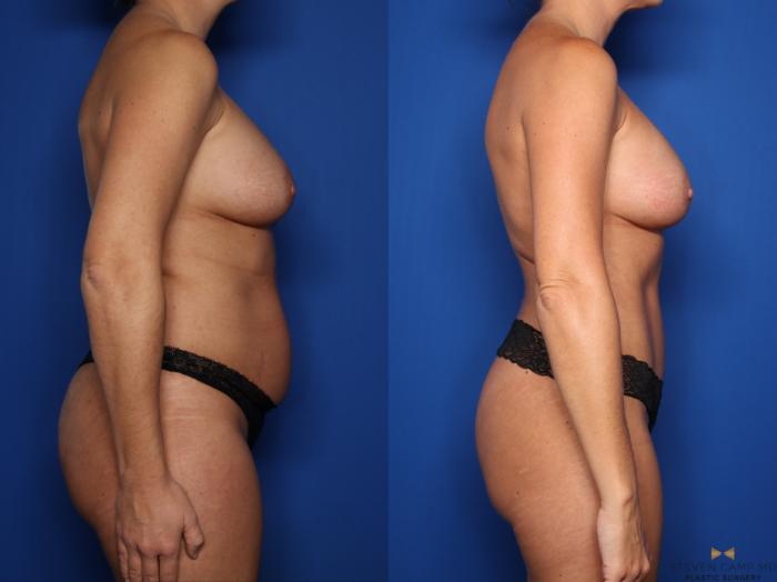 Before & After Renuvion Skin Tightening Case 683 Right Side View in Fort Worth & Arlington, Texas