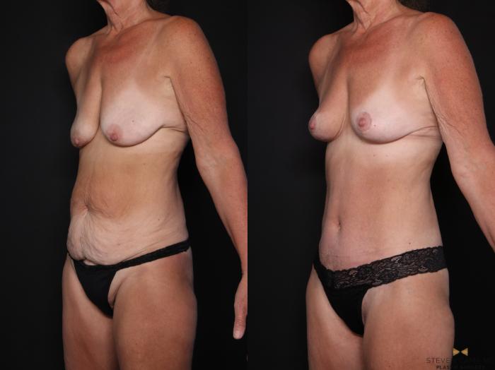 Before & After Mommy Makeover Case 725 Left Oblique View in Fort Worth & Arlington, Texas