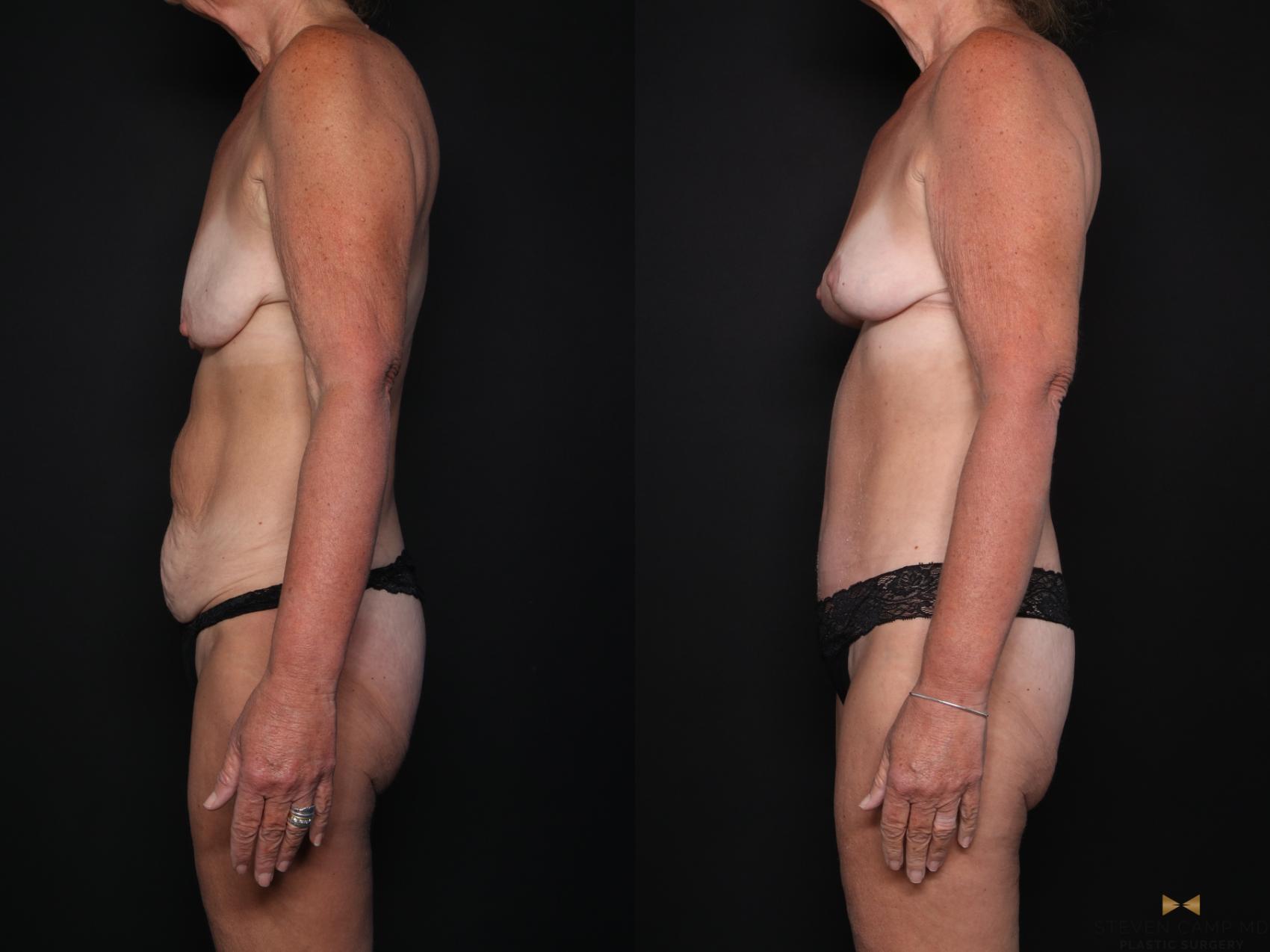 Before & After Tummy Tuck Case 725 Left Side View in Fort Worth & Arlington, Texas
