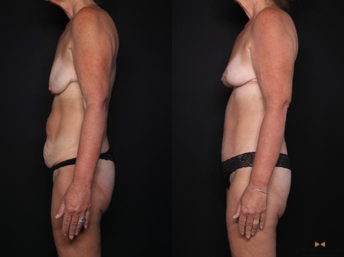 Before & After Mommy Makeover Case 725 Left Side View in Fort Worth & Arlington, Texas
